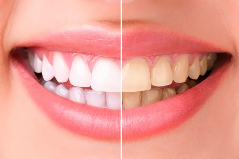 Отбеливание зубов по системе  KLOX со скидкой 35%